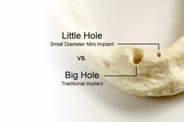 bone-mini-implants-vs-conventional