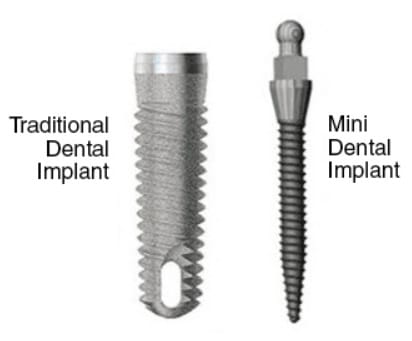 mini dental implants vs conventional mini dental implants vs conventional